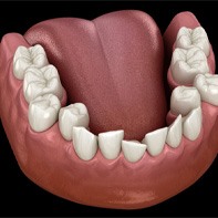 Illustration of crowded teeth