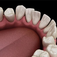 Illustration of gapped teeth