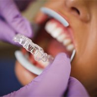 dentist putting Invisalign on patient