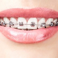 closeup of woman smiling with braces 
