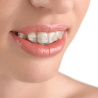 Closeup of smile with tooth-colored brackets and wires