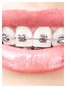 Teeth with traditional metal bracket and wire braces
