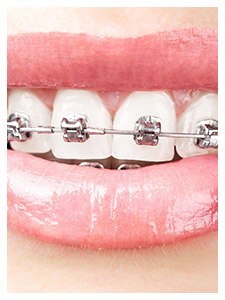Teeth with traditional metal bracket and wire braces