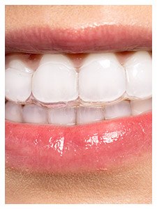 closeup of patient wearing Invisalign tray