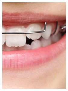 Closeup of smile with Phase 1 pediatric orthodontics