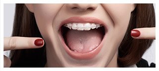 Smiling girl pointing to mouth with orthodontic appliance