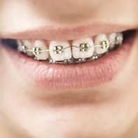 Canfield Traditional Braces  Bracket & Wire Orthodontics