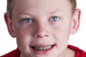 child smiling wearing braces