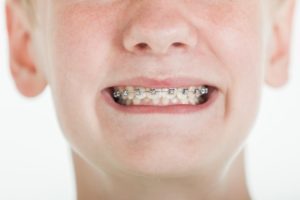 Boy smiling with braces