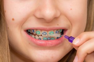 child with braces cleaning teeth