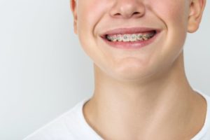 boy’s smile with braces between visits to his orthodontist