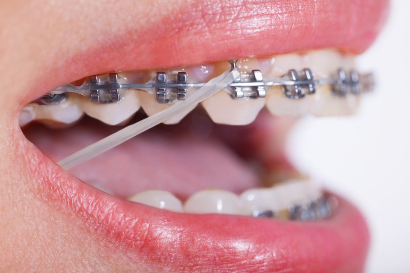 an up-close image of a person wearing braces with rubber bands