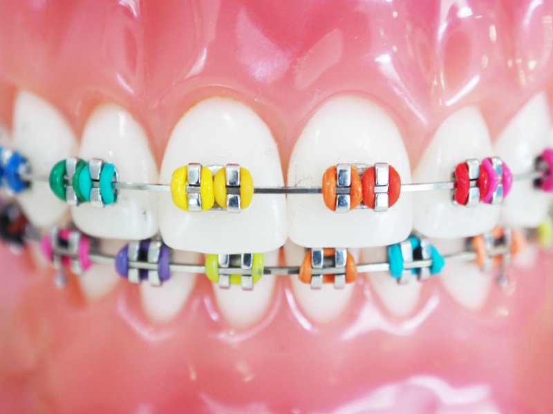 Braces with bands of various colors