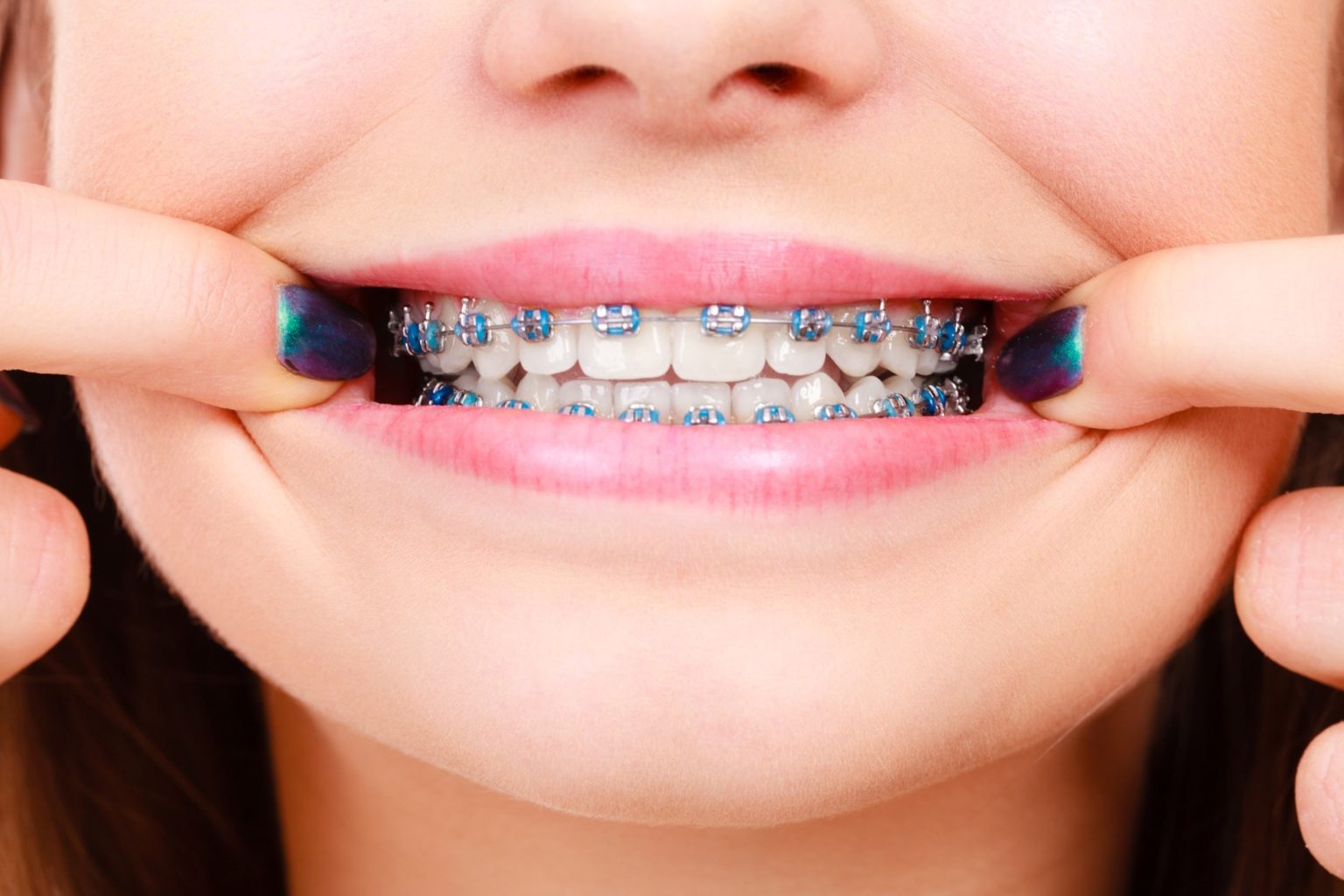 Fun Facts About Braces l Orthodontist Near You l Mikolich Orthodontics