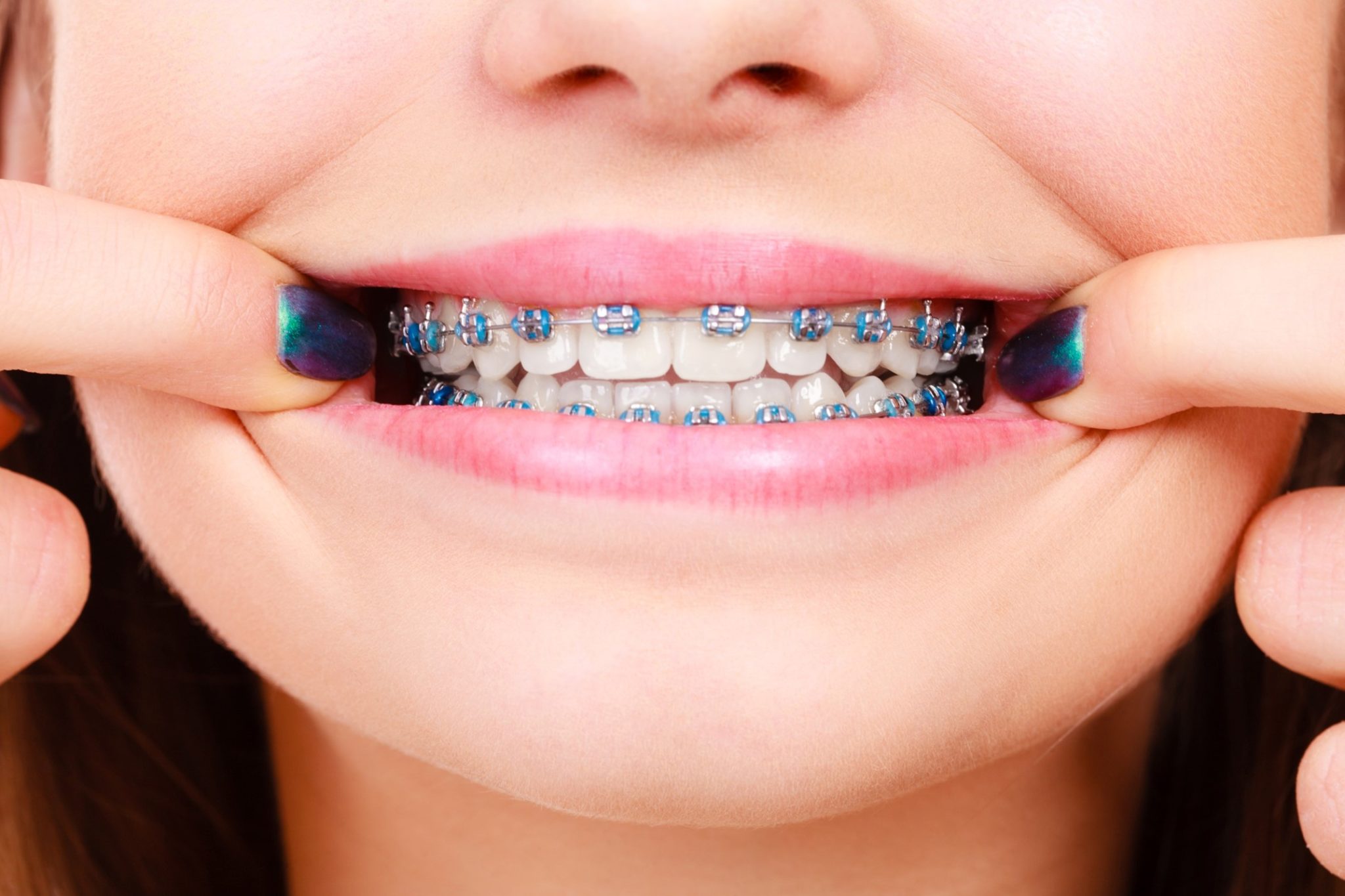 Fun Facts About Braces l Orthodontist Near You l Mikolich Orthodontics